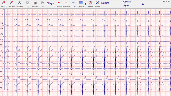 Class II 12 Channel Digital ECG Machine For Windows USB Connection EKG