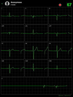 Wireless And Smart iPad ECG Device With Bluetooth Connection iCV200