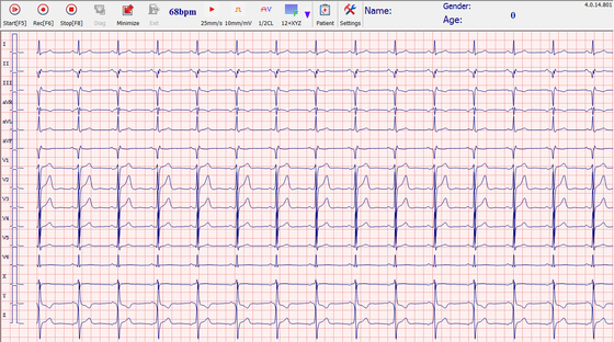 Heart echo stress test 500Hz , stress ecg test PC and box connecte