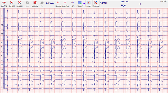 Heart echo stress test 500Hz , stress ecg test PC and box connecte